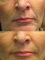 Nose to lip lines before/after treatment by Gillian M Lennox BDS MFGDP(UK)