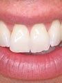 Tooth Whitening after treatment by Gillian M Lennox BDS MFGDP(UK)