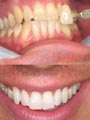 Tooth Whitening before/after treatment by Gillian M Lennox BDS MFGDP(UK)