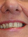 Before Inman Aligner treatment by Gillian Lennox